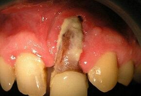 Osteomyelitis nach der Zähneextraktion